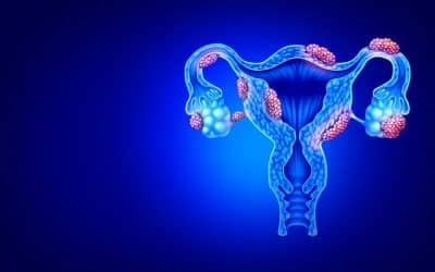 Policisztás ovárium szindróma