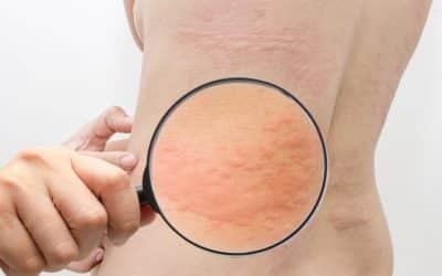 Hisztamin intolerancia